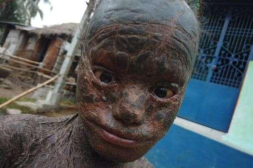 Boy, 10, dubbed ‘human snake’ because he sheds his skin every six weeks