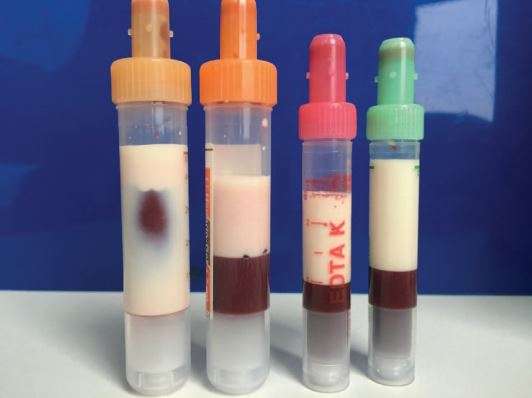 Why This Man’s Blood Turned ‘Milky’ Colored