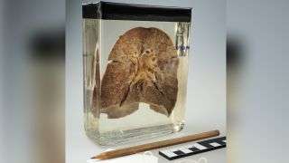 Formalin-fixed lung of 1912 measles patient