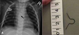 A 10-month-old child had an ornament hook stuck in her esophagus for several months before anyone discovered it. On the left, an X-ray of the child's chest showing the metal ornament hook (arrow), and on the right, a photo of the hook after it was removed. 