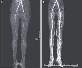 A burning pain in a woman's legs was due to ergotism, a disease that causes restriction of blood flow. The image shows a CT scan of the woman's legs before and after treatment for the disease.