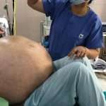 Huge ovarian tumour weighing almost 8 stone removed from 52-year-old woman