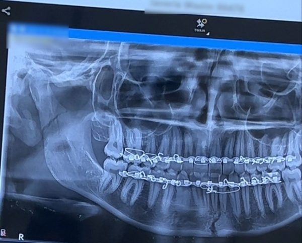 PIC FROM KENNEDY NEWS AND MEDIA (PICTURED: JAVERIA'S X-RAY REVEALED TWO FRACTURES IN HER JAW) A student was horrified when a 'jawbreaker' candy lived up to its name as she tried the 'dumb idea' of biting through it??? snapping her jaw in two places. Javeria Wasim and her friend decided to get 'giant' three-inch diameter jawbreakers while out shopping last month [19 November]. Once back at her university dorm room, the 19-year-old admits she became impatient to get to the gumball in the centre and tried to bite into the candy rather than licking her way through the treat. DISCLAIMER: While Kennedy News and Media uses its best endeavours to establish the copyright and authenticity of all pictures supplied, it accepts no liability for any damage, loss or legal action caused by the use of images supplied and the publication of images is solely at your discretion. SEE KENNEDY NEWS COPY - 0161 697 4266