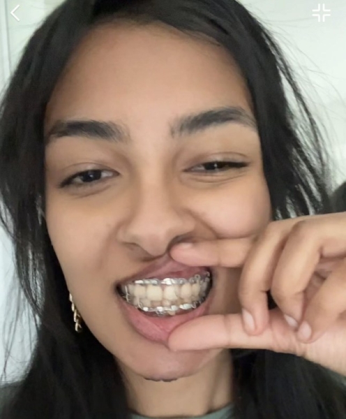 PIC FROM KENNEDY NEWS AND MEDIA (PICTURED: JAVERIA WASIM, 19, WHO HAD HER JAW WIRED SHUT FOR SIX WEEKS AFTER BREAKING IT) A student was horrified when a 'jawbreaker' candy lived up to its name as she tried the 'dumb idea' of biting through it??? snapping her jaw in two places. Javeria Wasim and her friend decided to get 'giant' three-inch diameter jawbreakers while out shopping last month [19 November]. Once back at her university dorm room, the 19-year-old admits she became impatient to get to the gumball in the centre and tried to bite into the candy rather than licking her way through the treat. DISCLAIMER: While Kennedy News and Media uses its best endeavours to establish the copyright and authenticity of all pictures supplied, it accepts no liability for any damage, loss or legal action caused by the use of images supplied and the publication of images is solely at your discretion. SEE KENNEDY NEWS COPY - 0161 697 4266