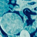 Diagnostic dilemma: Strange lump in woman's thigh turns out to be a sponge left over from a C-section.
