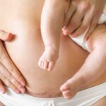 Study finds elective cesarean section linked to increased risk of childhood leukemia