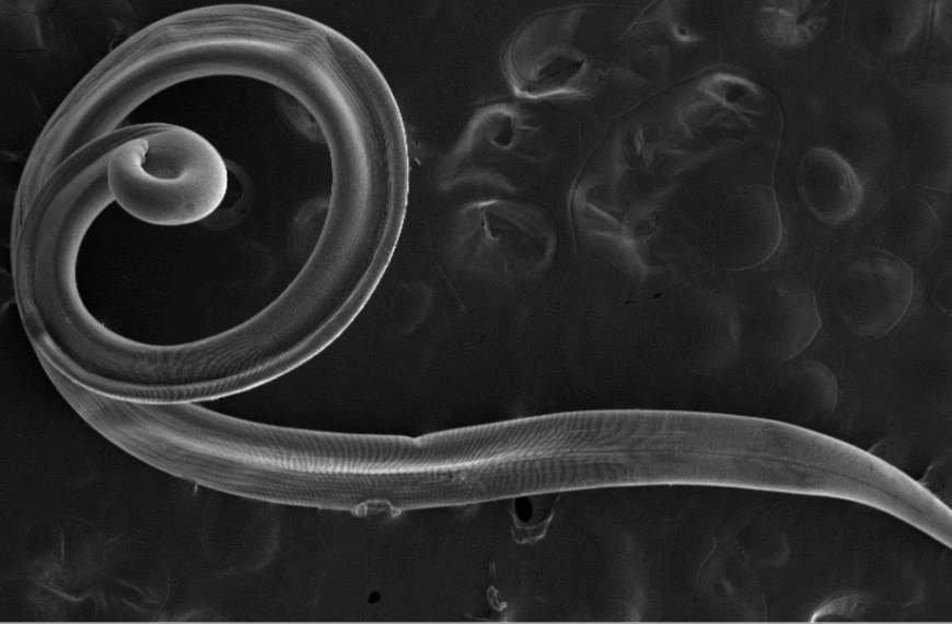 Diagnostic dilemma: Woman gets something in her eye – and it turns out to be parasitic worms.