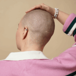 Why do some people grow 'chemical curls' after cancer treatment?