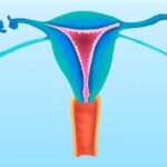 How does the tubal ligation procedure work?