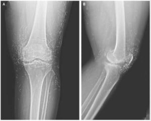 Diagnostic dilemma: Woman's severe knee pain suggests 'golden threads' in her joints