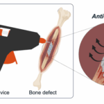 Scientists have developed a “glue gun” that 3D prints bone grafts directly…