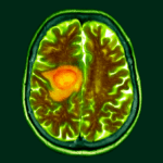 Early research suggests changing diet could make brain cancer treatment easier