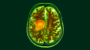 Early research suggests changing diet could make brain cancer treatment easier