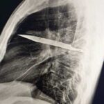 Diagnostic dilemma: a man has a knife break in his chest and…