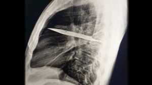 Diagnostic dilemma: a man has a knife break in his chest and…