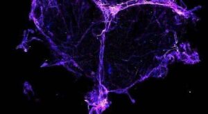 Brain drainage system damage: A possible cause of ‘chemo brain’.