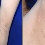 Baffling Case: Woman’s Underarm Lactation Turns Out to Be Accessory Breast Tissue