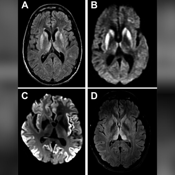 An extremely rare disorder that causes holes to form in the brain