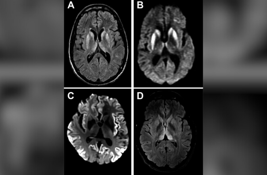 An extremely rare disorder that causes holes to form in the brain