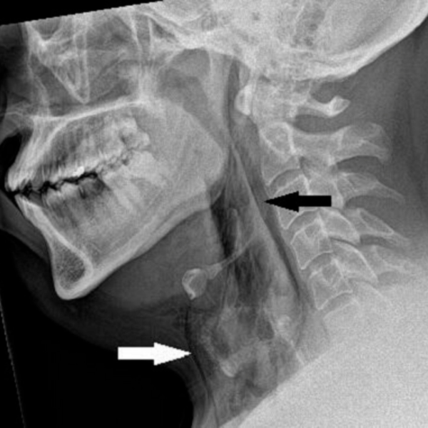Diagnostic dilemma: Man delays sneezing, punctures his trachea