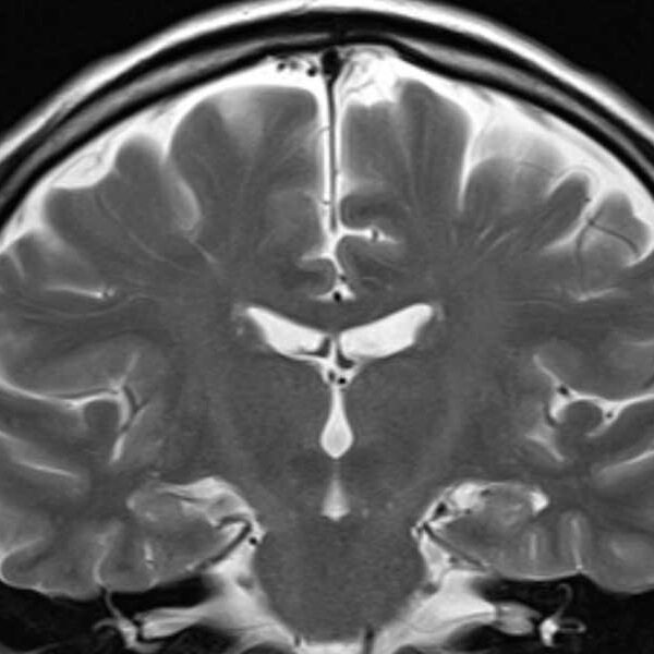 Scientists Claim One MRI Can Reveal How Fast You’re Aging