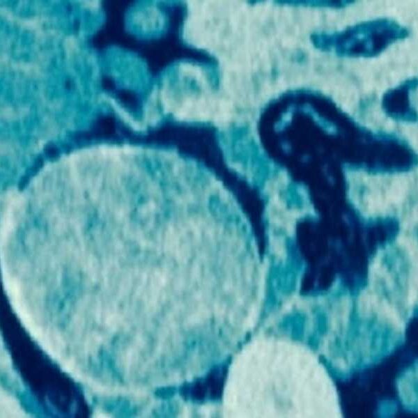 Diagnostic dilemma: Strange lump in woman’s thigh turns out to be a&hellip;