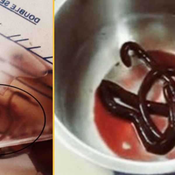 Diagnostic dilemma: A man who couldn’t urinate was infected with one of…