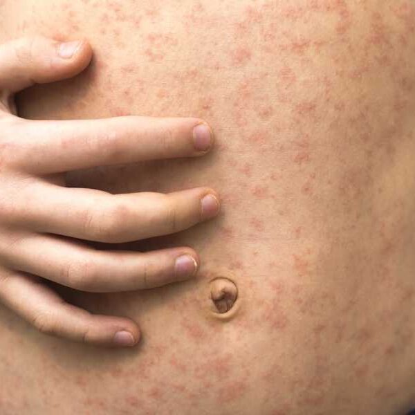 ‘We’re already on the brink of disaster’: Deadly measles outbreaks could erupt&hellip;
