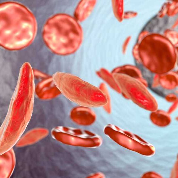 Dangerous sickle cell ‘crises’ may be aggravated by menstrual cycle