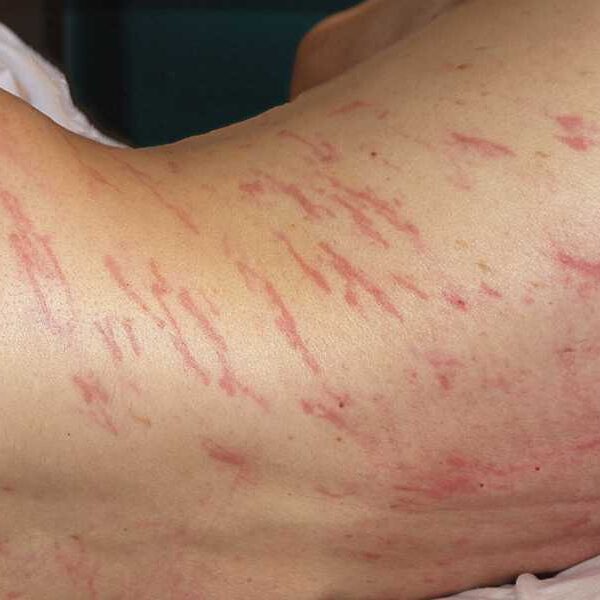 Diagnostic dilemma: Rash ‘migrated’ across man’s body from his anus
