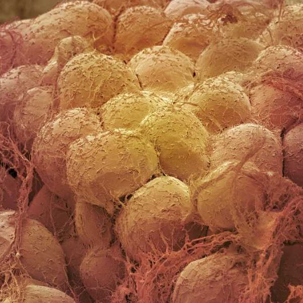 Losing weight can ‘rejuvenate’ fat tissue by getting rid of old cells