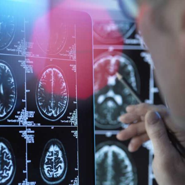 100% fatal brain disease hits 3 in Oregon