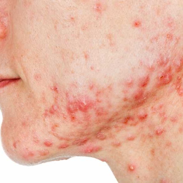 Acne vaccine: Experimental injection to treat common skin condition reaches clinical trials.&hellip;