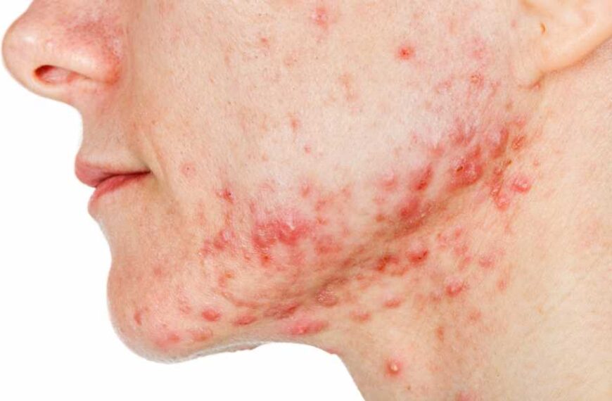 Acne vaccine: Experimental injection to treat common skin condition reaches clinical trials.&hellip;