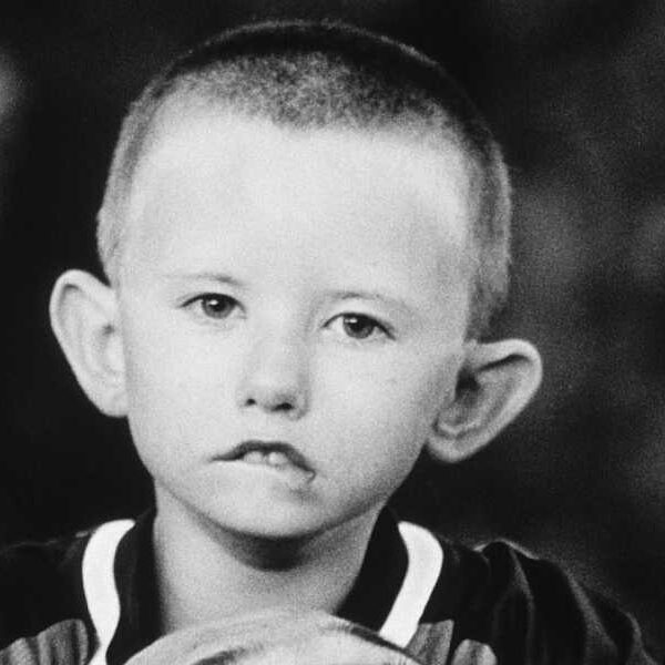 Moebius syndrome: a rare disorder that prevents people from smiling