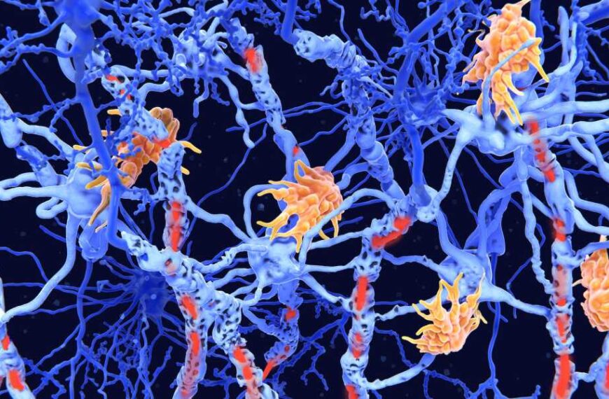 Twin study reveals signs of multiple sclerosis that can be&hellip;