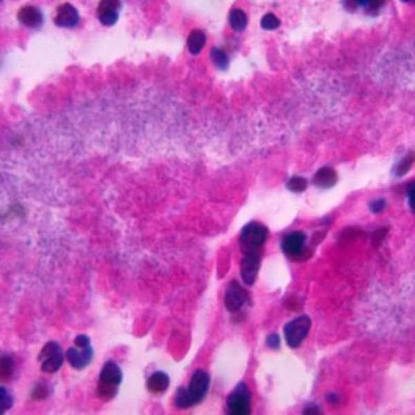 This rare bacterial infection causes pus-filled ulcers to form in the lungs&hellip;