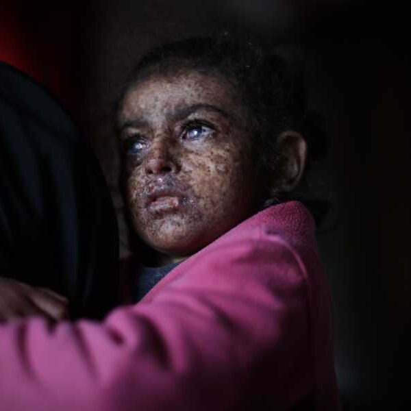 What is xeroderma pigmentosum? A rare genetic disorder that causes people to&hellip;