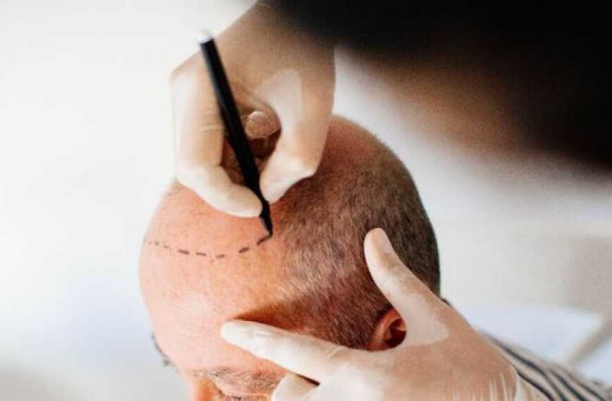 Briton Dies in Turkey After Hair Transplant Amid ‘Murder’ Case