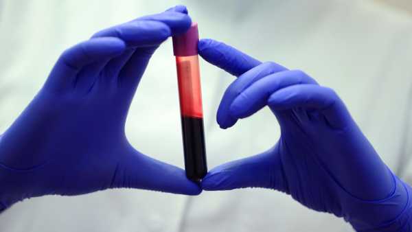 A new blood test is designed to detect liver scarring&hellip;