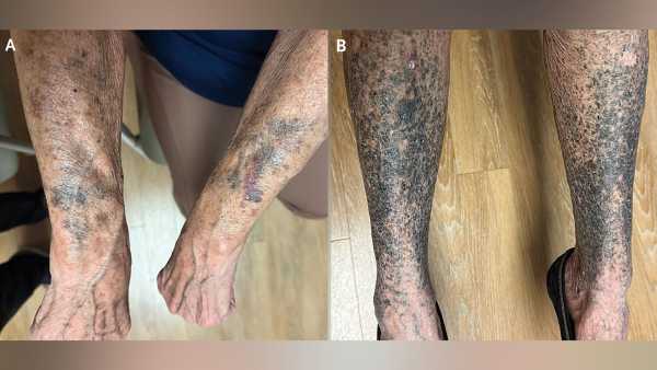 Diagnostic quandary: Bruises surfaced on a woman’s skin, and an antibiotic was&hellip;