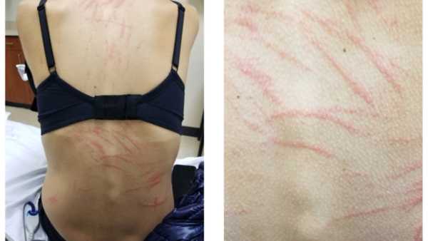 Diagnostic quandary: Blistering rashes erupted on a woman’s back after consuming shiitake&hellip;