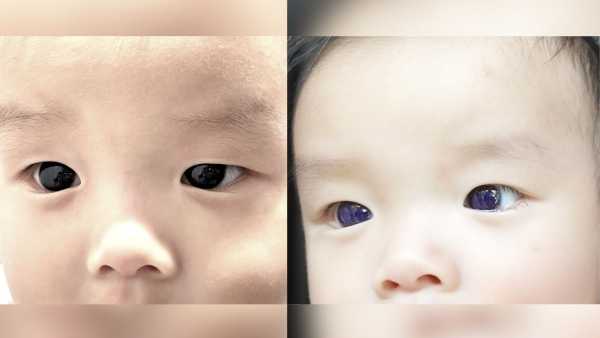 The infant’s brown eyes turned indigo following COVID antiviral therapy,&hellip;